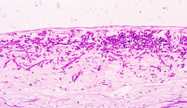 Histopathology of invasive candidiasis. Left: PAS stain showing magenta-staining yeast and pseudohyphae in tissue. Right: GMS stain highlighting black fungal elements against a green counterstain.