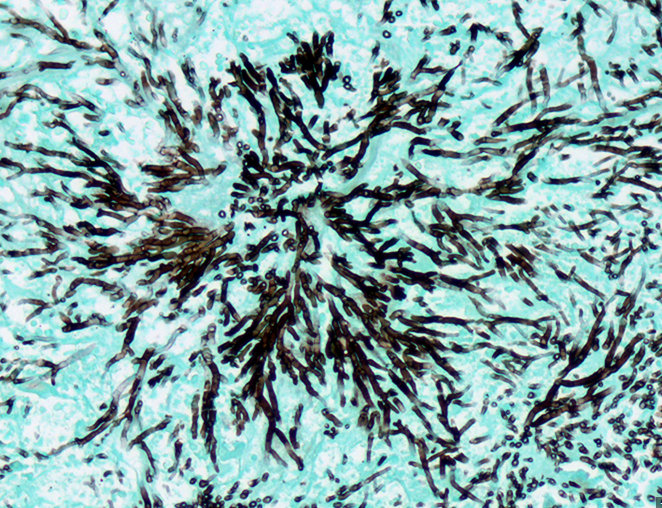 Histopathology of invasive aspergillosis. Left: GMS stain in tissue showing dichotomously branching septate hyphae with characteristic 45° (acute-angle) branching. Right: Calcofluor white stain on BAL specimen highlighting hyphal elements under fluorescence microscopy.