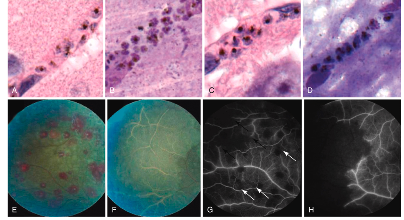 Cerebral malaria sequestration histology and retinal angiography